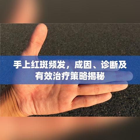 手上紅斑頻發(fā)，成因、診斷及有效治療策略揭秘